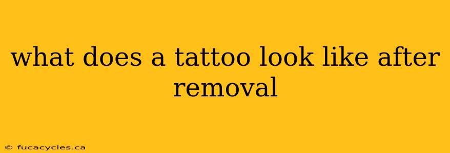 what does a tattoo look like after removal