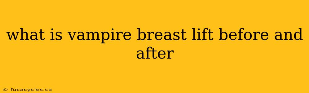 what is vampire breast lift before and after